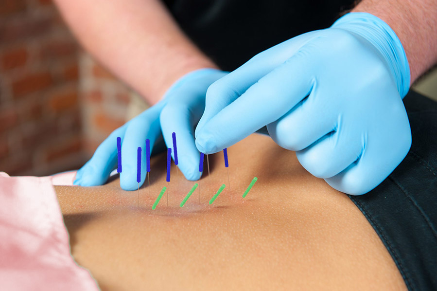 Dry needling treatment