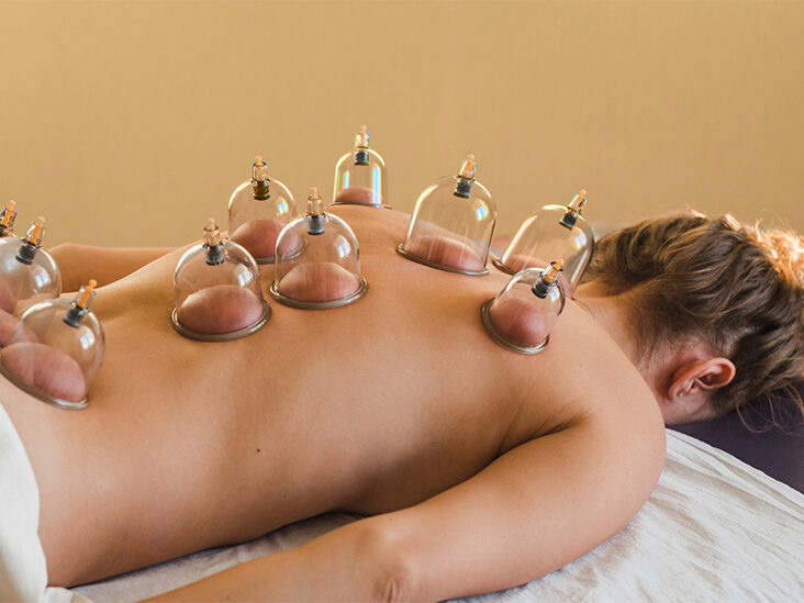 Cupping therapy on a patient's back