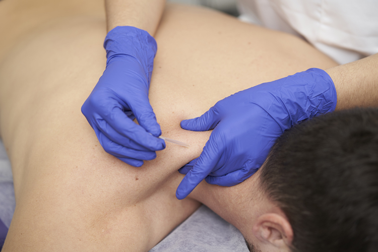 Dry Needling